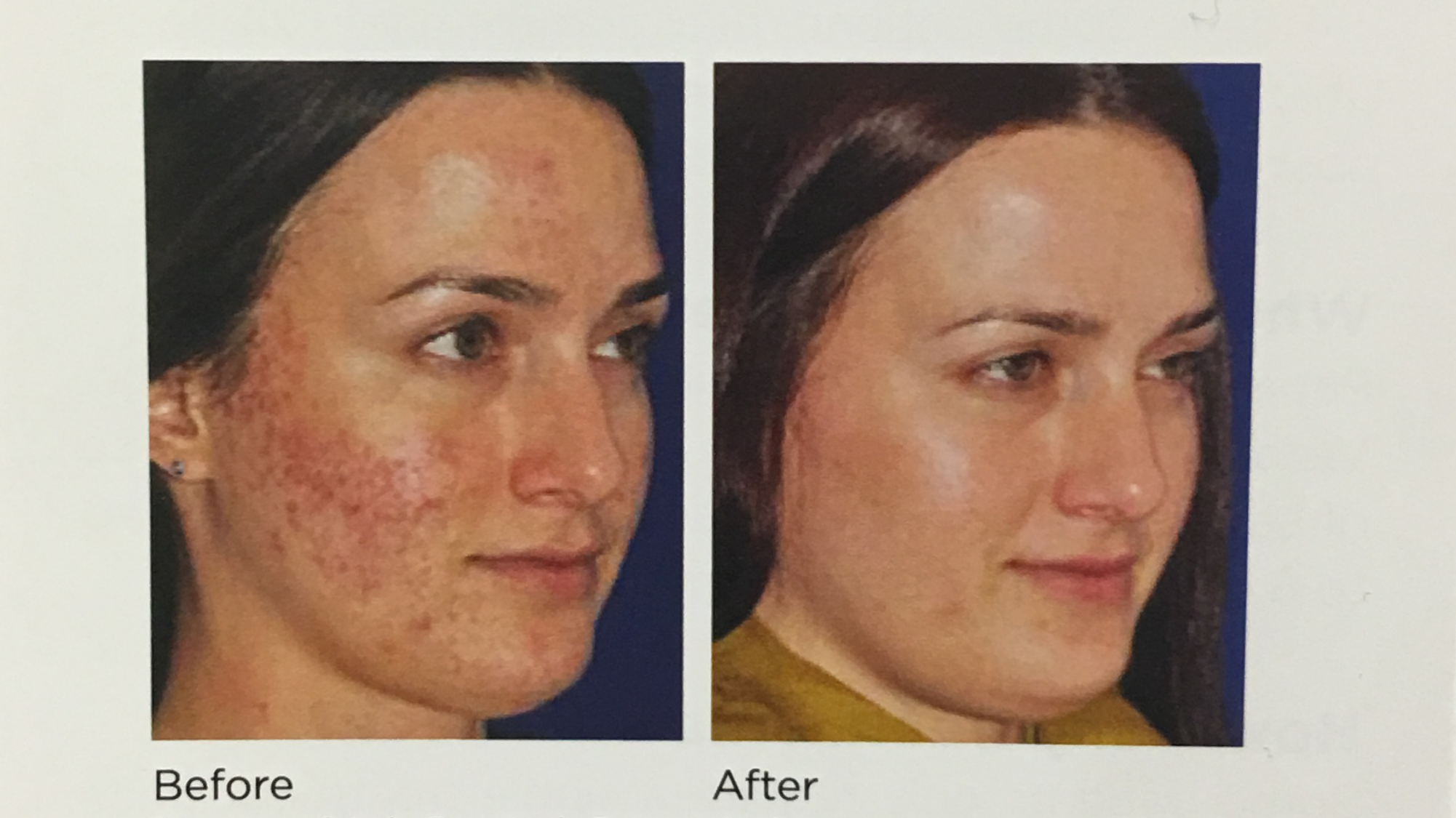 THE MIRACLE OF MICRONEEDLING